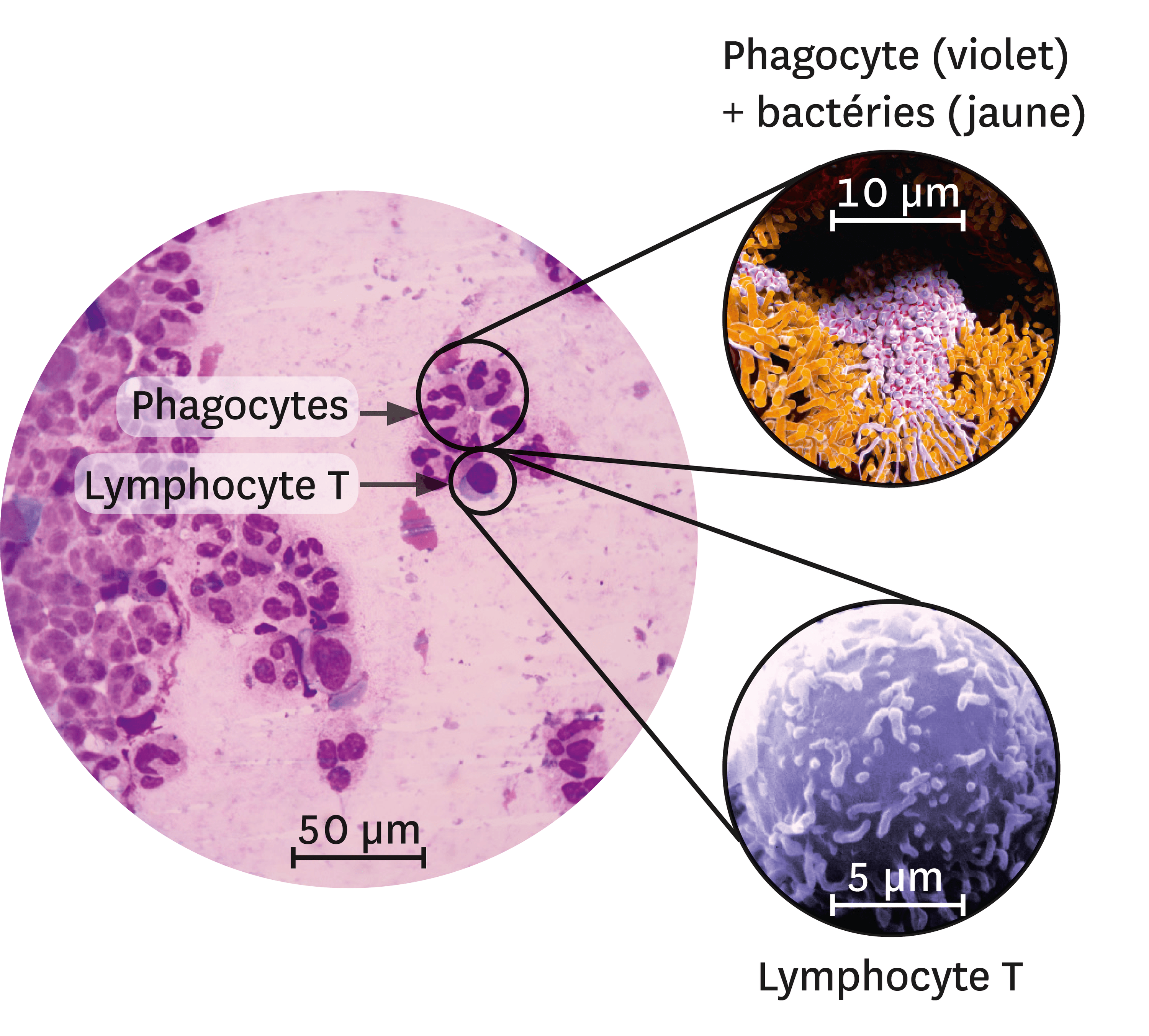 Différents Types De Leucocytes Sur Le Site D'une Infection.